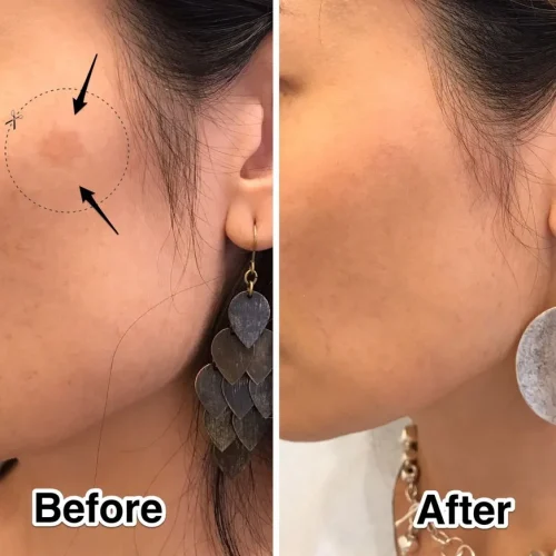 pico-q-laser-before-and-after pico-q-laser-before-and-after